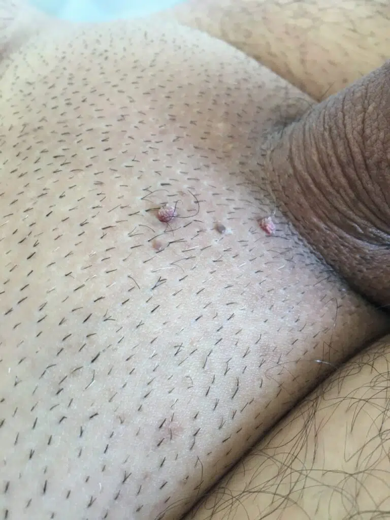 hpv fotos