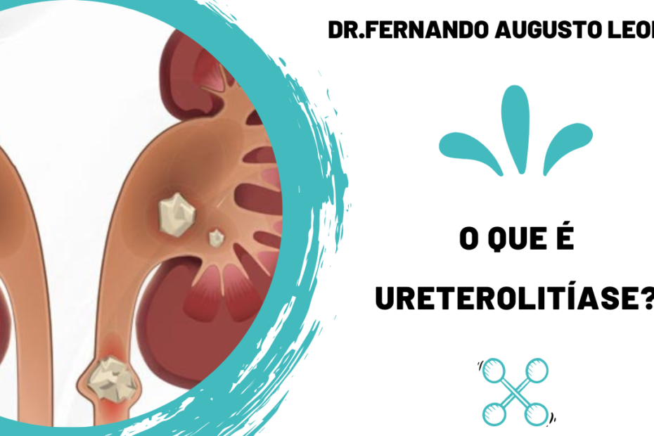 ureterolitíase