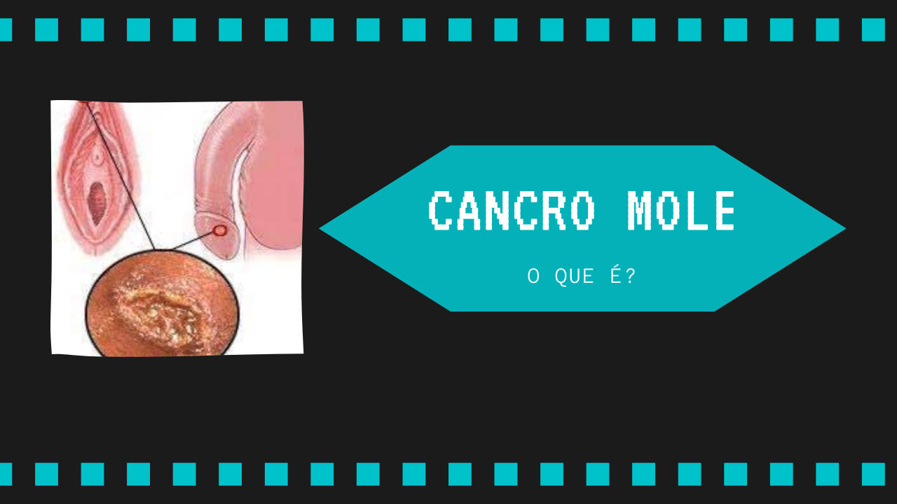 O que é o cancro mole?