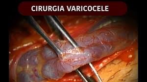 varicocele