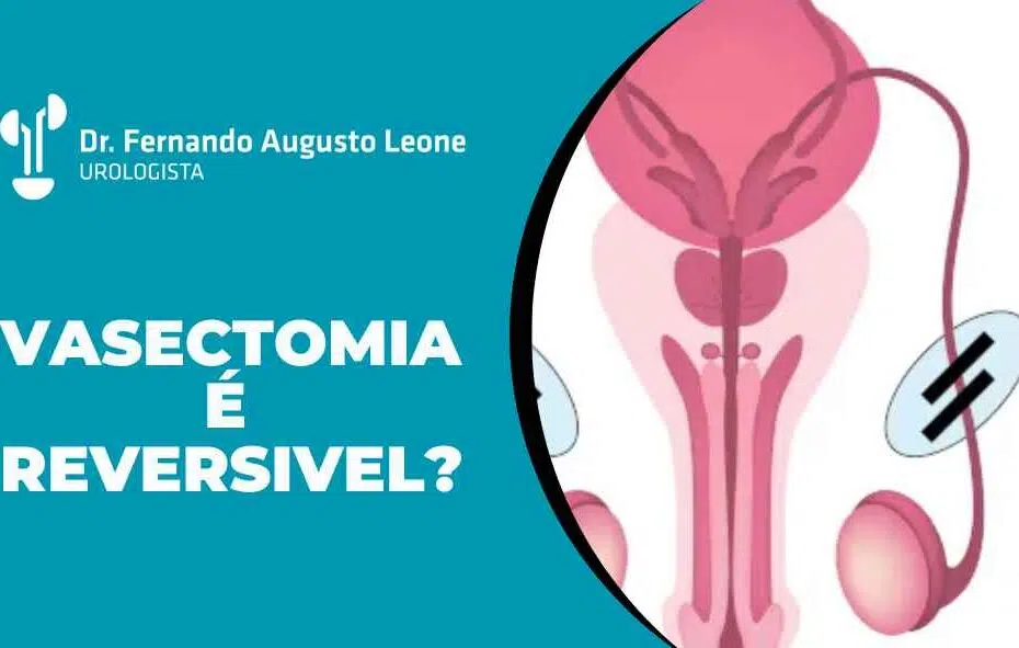 Vasectomia é reversivel