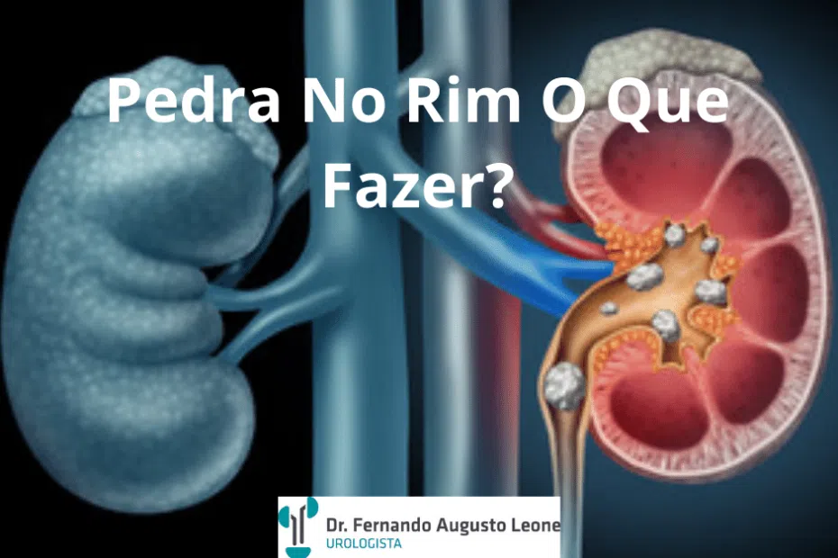 Pedra No Rim O Que Fazer?