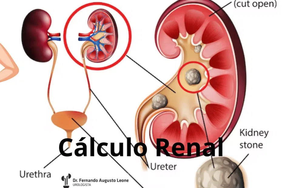 Cálculo Renal