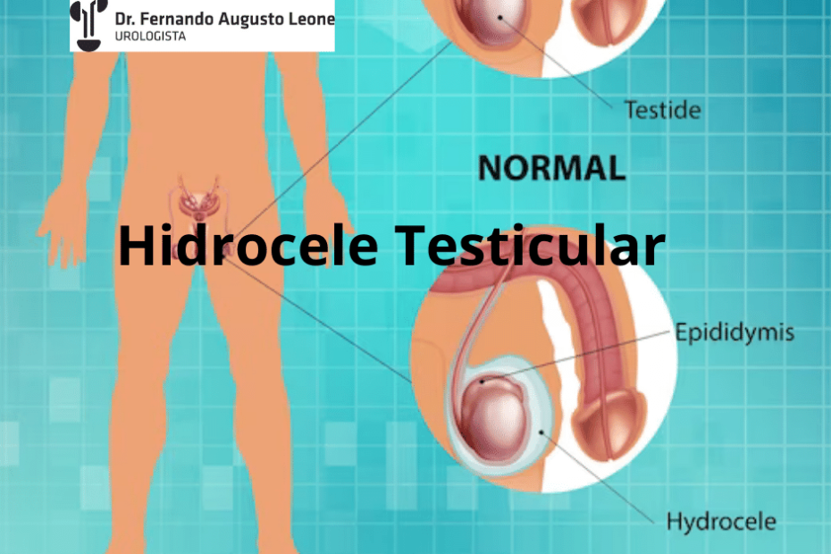 Hidrocele Testicular