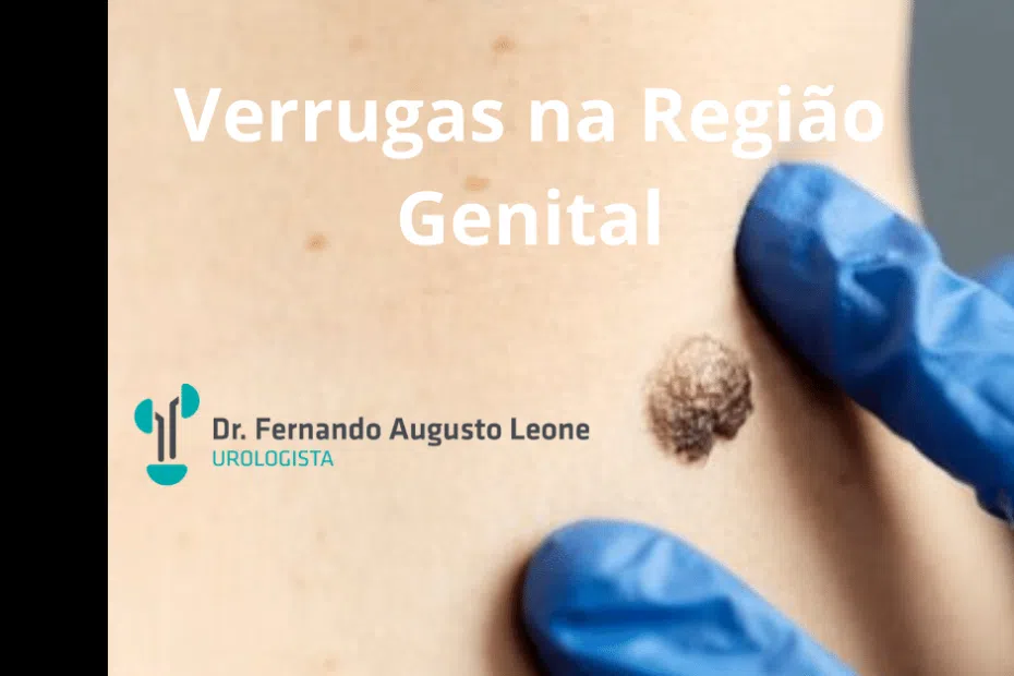 Verrugas na Região Genital